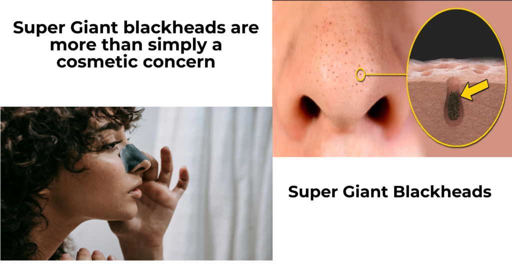 Super Giant blackheads